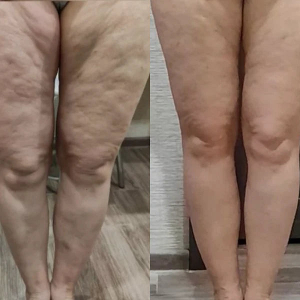Cellulite Relief Kit