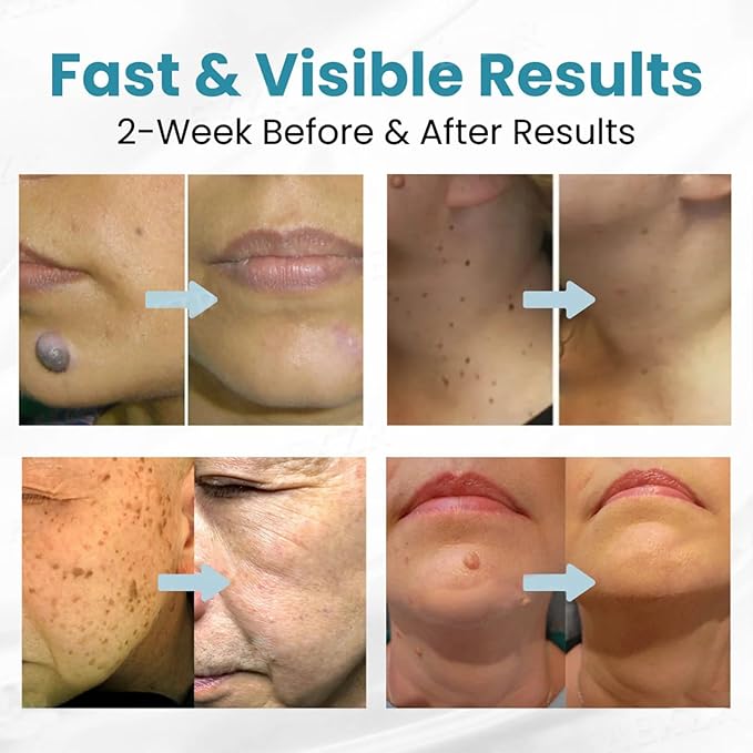 قلم إزالة الشامات والثآليل غير الجراحي